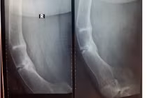 Phẫu thuật thành công ca gãy xương thủy tinh nặng 