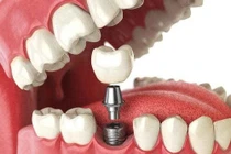 Mất răng và cấy ghép implant