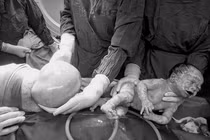 Một bé trong đôi song sinh chào đời nguyên bọc ối