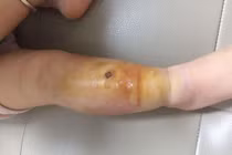 Viêm mô tế bào nguy hiểm