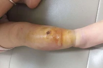 Viêm mô tế bào nguy hiểm