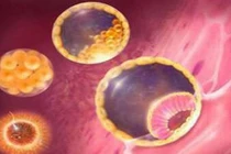  Không mang thai bị ung thư nhau thai