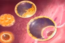  Không mang thai bị ung thư nhau thai