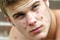 Bỉ áp dụng cách ly bắt buộc đối với người mắc đậu mùa khỉ