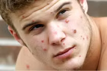 Bỉ áp dụng cách ly bắt buộc đối với người mắc đậu mùa khỉ