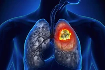 Yếu tố tiềm ẩn gây ra ung thư phổi ở nữ giới