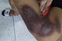 Nhiều trẻ bị tổn thương bàn tay nặng do pháo tự chế