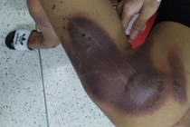 Nhiều trẻ bị tổn thương bàn tay nặng do pháo tự chế