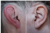 Đỏ tai và đau nửa đầu