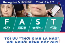  Lệch mặt do đột quỵ lại tưởng liệt dây thần kinh