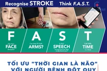  Lệch mặt do đột quỵ lại tưởng liệt dây thần kinh