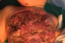 Hoại tử bụng và ngực vì đắp lá chữa bỏng