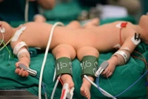 CLIP: Vừa tách rời hoàn toàn 2 bé song sinh Trúc Nhi - Diệu Nhi