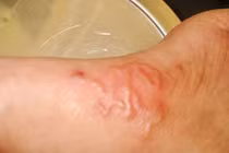 Lấy xong ổ giun lươn đã hết bệnh?