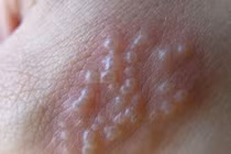 Rộp mụn nước sau khi cháy nắng