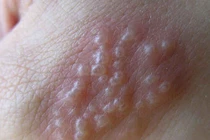 Rộp mụn nước sau khi cháy nắng