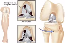 Thời gian điều trị chấn thương dây chằng