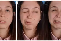 Méo miệng, liệt mặt vì thức khuya