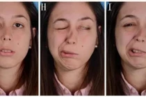 Méo miệng, liệt mặt vì thức khuya