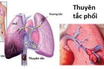 Thuyên tắc huyết khối tĩnh mạch - “kẻ sát nhân thầm lặng”
