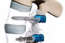 Phương pháp điều trị xẹp đốt sống nặng do loãng xương