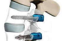 Phương pháp điều trị xẹp đốt sống nặng do loãng xương