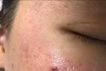 Những điều nên làm với da mụn