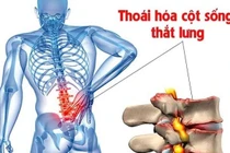 Thuốc Đông y trị thoái hóa cột sống lưng