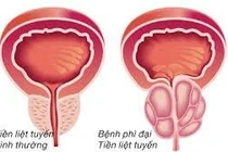 Tự chữa bí đái thành suy thận