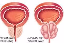 Tự chữa bí đái thành suy thận