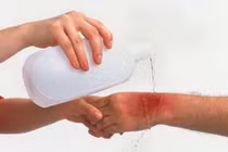 Xử lý khi bị sứa cắn