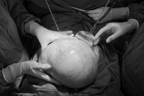 Chủ quan không khám lại, u buồng trứng nặng 6kg chuyển ác tính