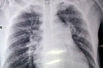 Đau ngực đột ngột cẩn thận tắc mạch phổi