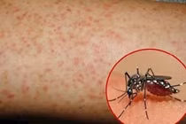 Dấu hiệu của bệnh sốt xuất huyết 