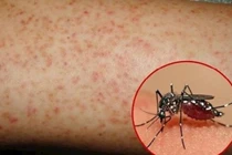 Dấu hiệu của bệnh sốt xuất huyết 