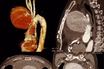 Chỉ phù mặt người đàn ông “thoát chết” vì phình động mạch chủ “khổng lồ”