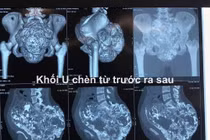 Khối u khủng gây teo thận