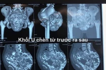 Khối u khủng gây teo thận