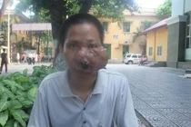 Ngạt mũi cẩn thận bệnh granulôm ác tính