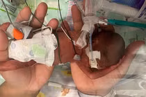 Chào đời chỉ 21 tuần tuổi, cậu bé phá kỷ lục sinh non nhất thế giới