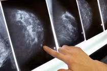 Những bất thường vùng 'núi đôi' cảnh báo ung thư