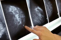 Những bất thường vùng 'núi đôi' cảnh báo ung thư