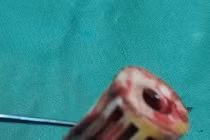 Lấy lô cuốn tóc trong vùng kín cho cụ bà 81 tuổi