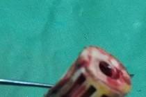 Lấy lô cuốn tóc trong vùng kín cho cụ bà 81 tuổi