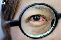 Viêm màng bồ đào có thể ảnh hưởng toàn cơ thể