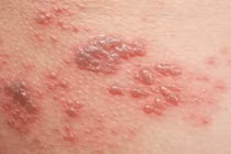 Các bài thuốc Đông y cho từng thể bệnh zona thần kinh