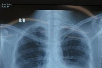 Tràn dịch dưỡng chấp sau vét hạch cổ 