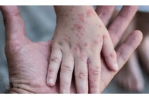 Đeo khẩu trang phòng chống đậu mùa khỉ ? 