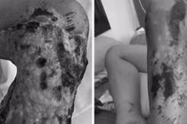 Đắp lá phá chân