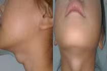 Bướu cổ làm cho cổ họng ứ đầy